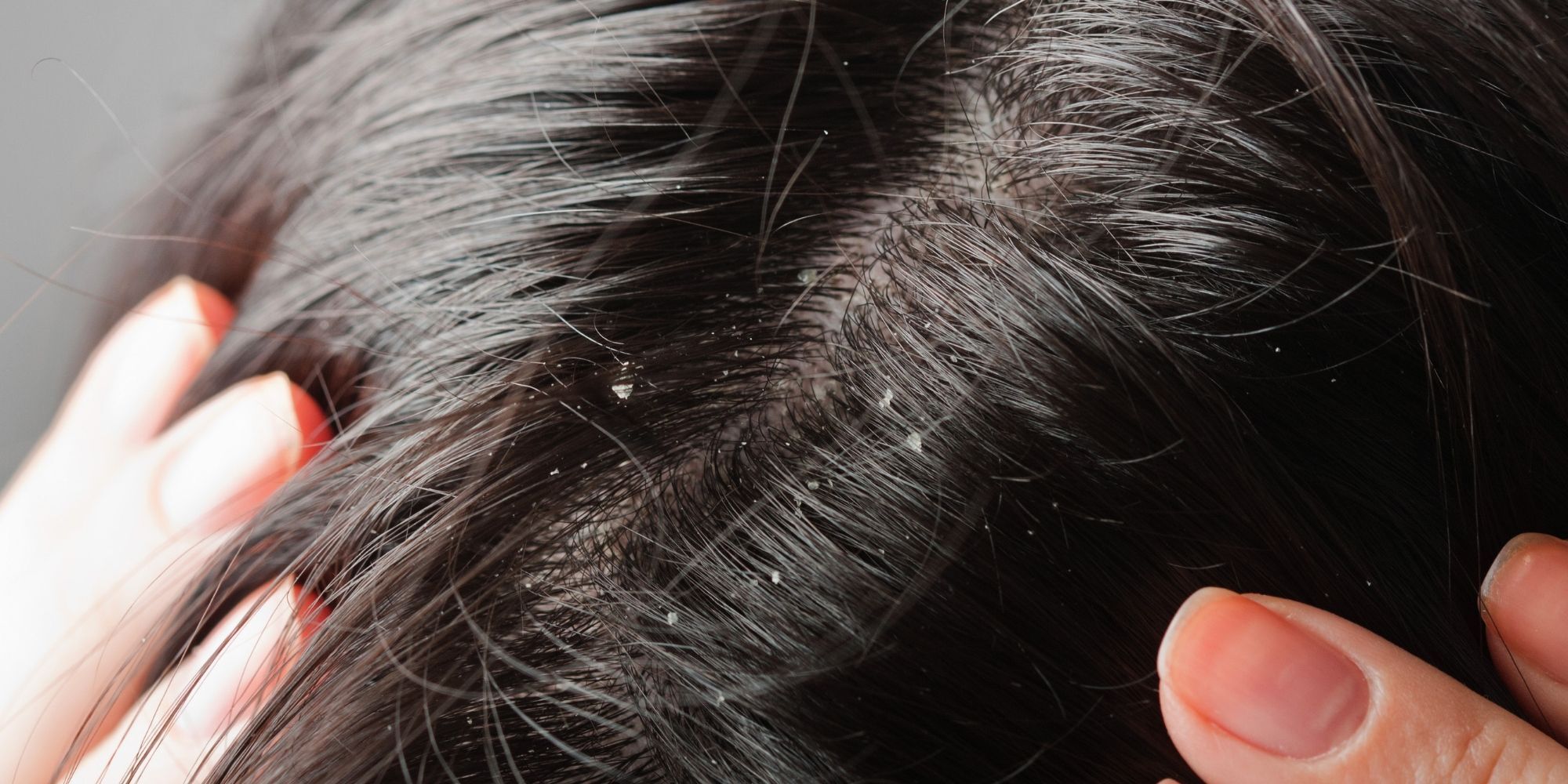 wanita dengan ketombe di kulit kepala