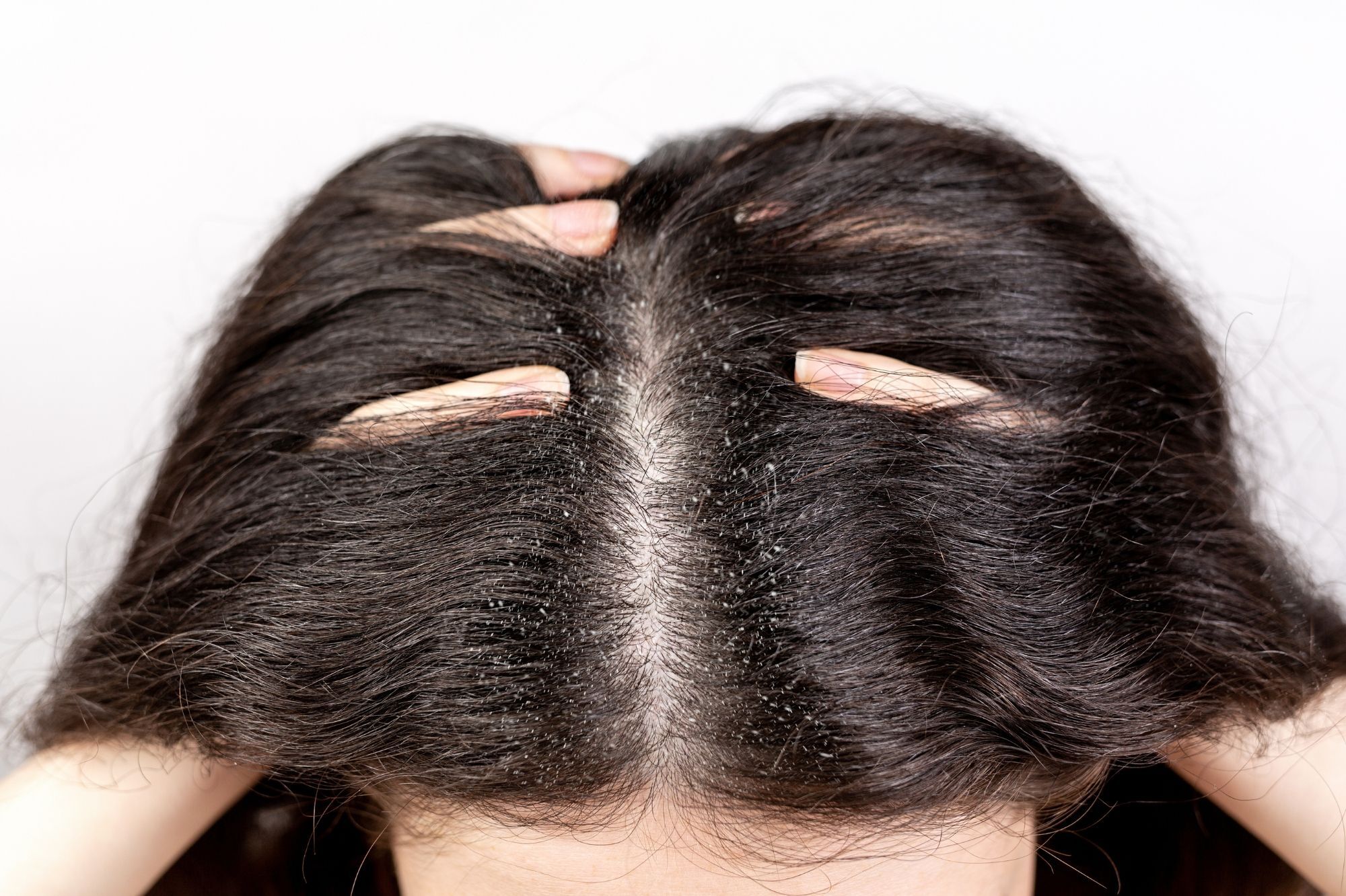 wanita dengan ketombe yang bikin stress