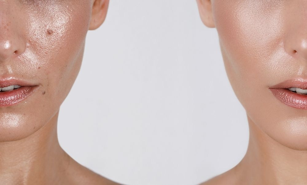 ผิวหน้ามันรูขุมขนกว้างหาสาเหตุหน้ามัน