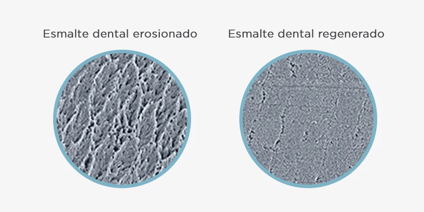 ¿Qué provoca la erosión del esmalte?