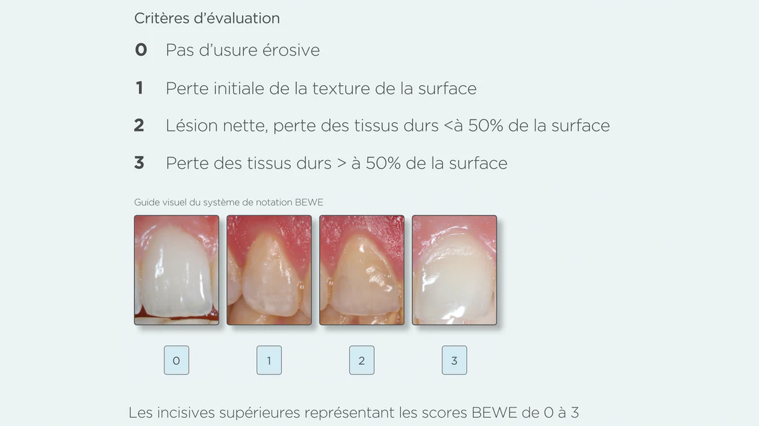 diagnostic de l'érosion de l'émail chez les patients
