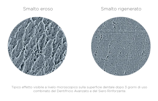 Cos’è l’erosione dentale?