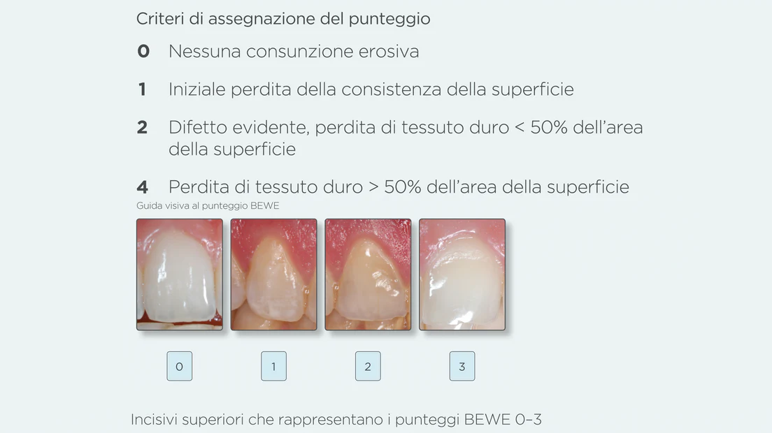 DIAGNOSTICARE L’EROSIONE DELLO SMALTO DENTALE IN CLINICA