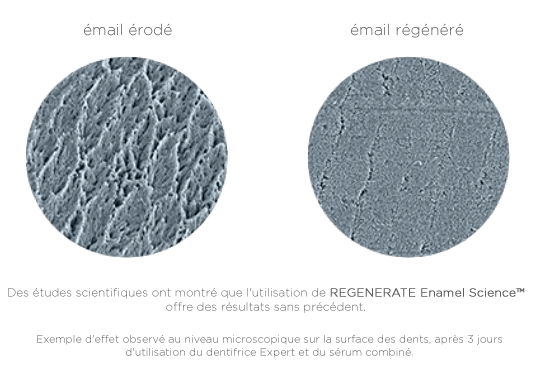 Qu’est-ce que l’érosion de l’émail?