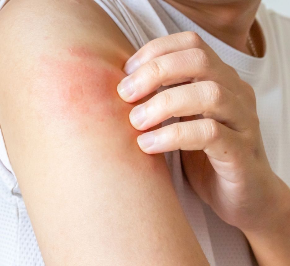 Man scratching his arm until his skin is red.
