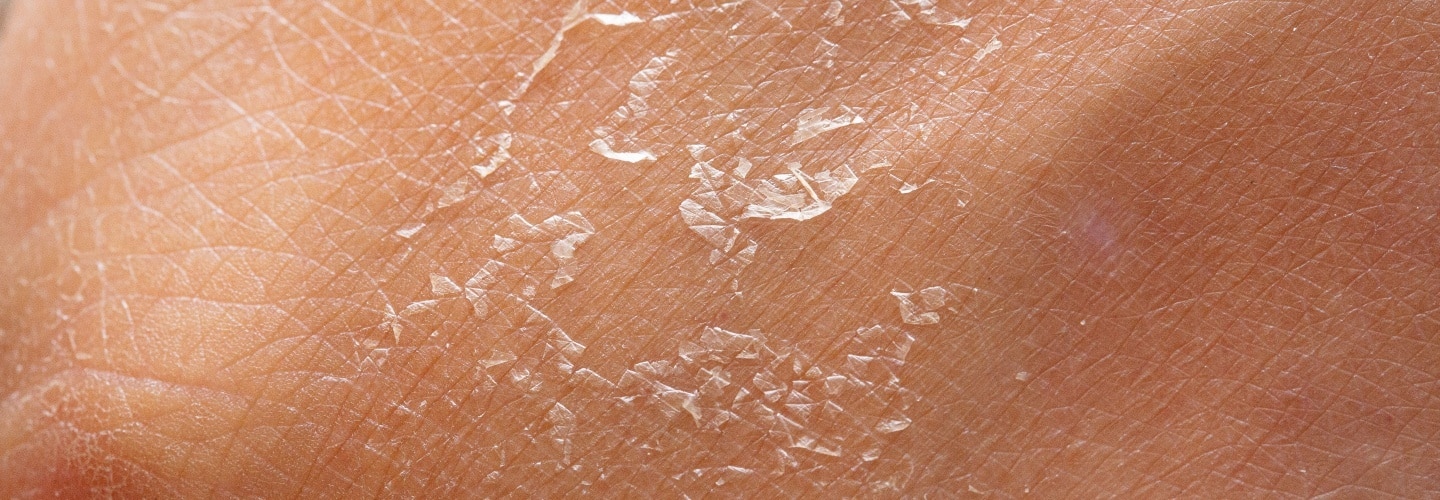 5 Cara Cepat Memperbaiki Skin Barrier yang Rusak 