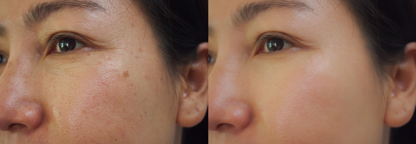 Signs of Age Spots and the Skincare Recommendation