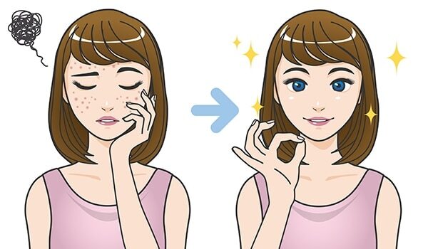 How To Remove Pimple Marks With Effective Home Remedies