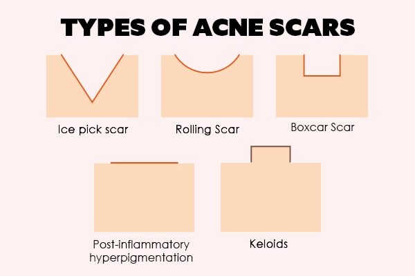 FAQs about pimple marks