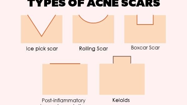 FAQs about pimple marks