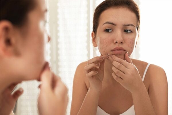 FAQs about pimple marks