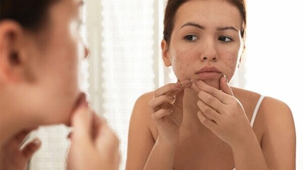 FAQs about pimple marks