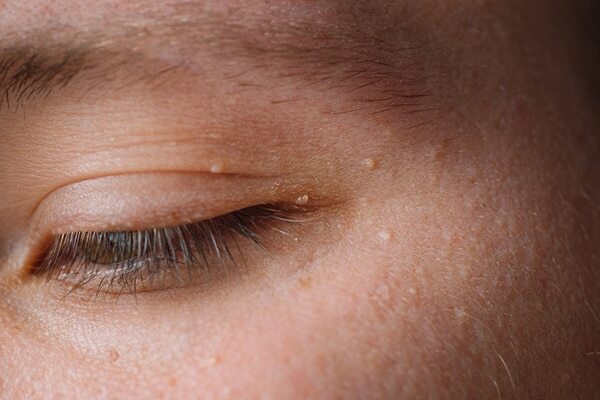FAQs on getting rid of milia on the face