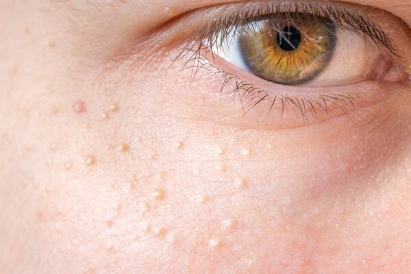FAQs on getting rid of milia on the face
