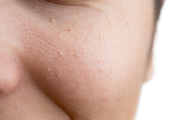 FAQs on getting rid of milia on the face