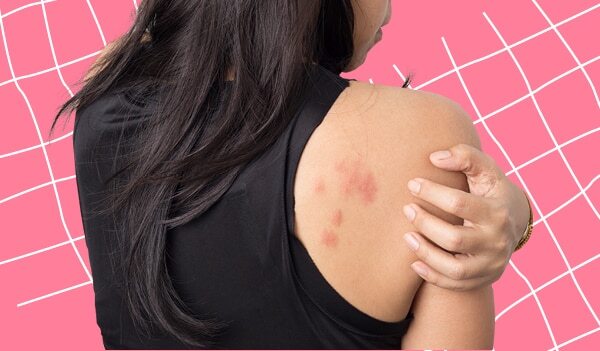 What Is A Stress Rash And Effective Ways To Deal With It
