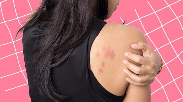 What Is A Stress Rash And Effective Ways To Deal With It