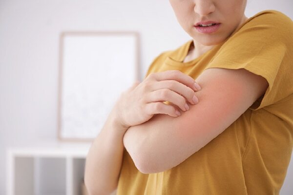 FAQs about stress rash