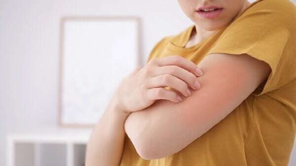 FAQs about stress rash