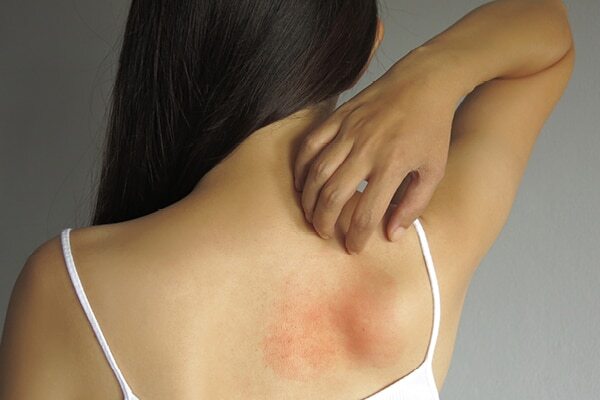 FAQs about stress rash