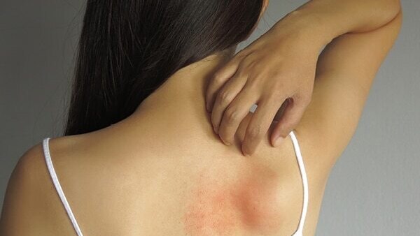FAQs about stress rash