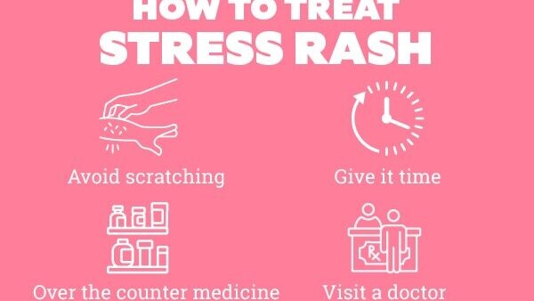 FAQs about stress rash