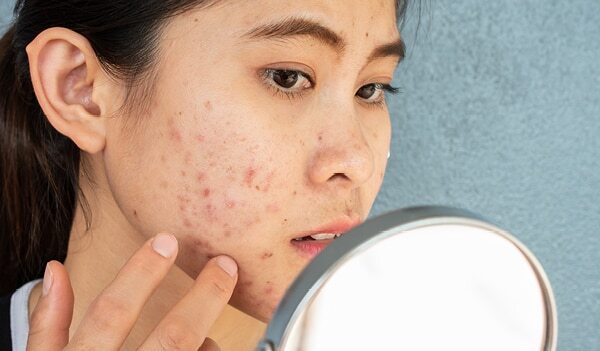 What Is Nodular Acne And How To Treat It