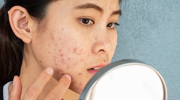 What Is Nodular Acne And How To Treat It