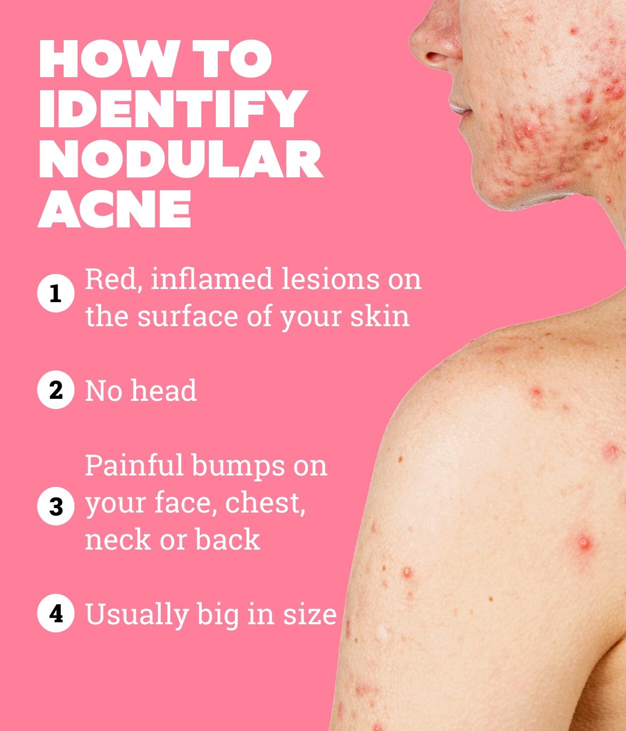 How to prevent nodular acne?