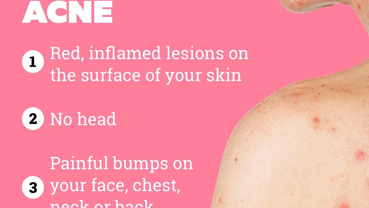 How to prevent nodular acne?