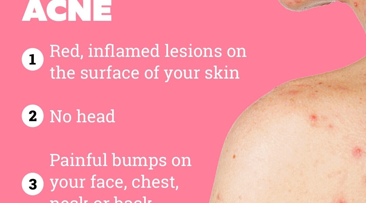 How to prevent nodular acne?