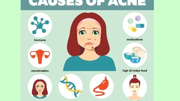 How to prevent nodular acne?