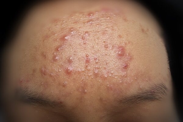 How to prevent nodular acne?