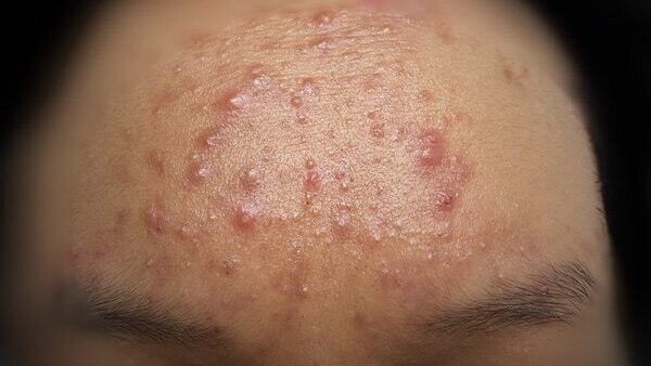 How to prevent nodular acne?