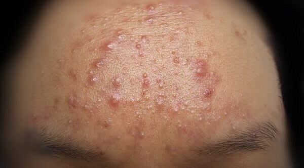 How to prevent nodular acne?