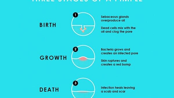 Stages :