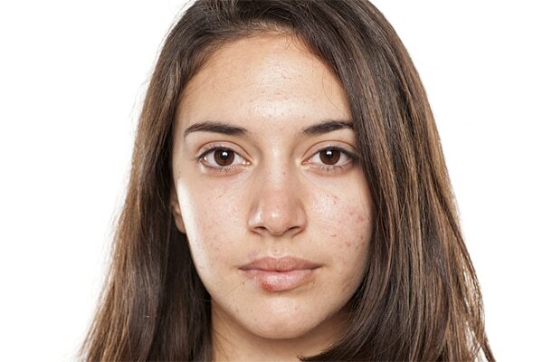 Skin impurities