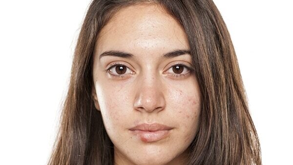 Skin impurities