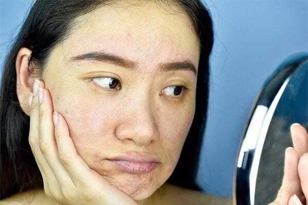Skin impurities