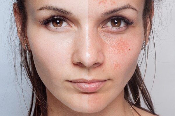 Skin impurities