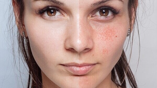 Skin impurities