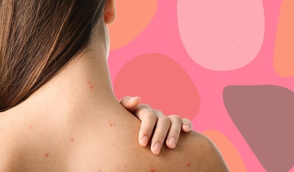 Fungal Acne Treatment: How To Identify And Treat FungalAcne At Home