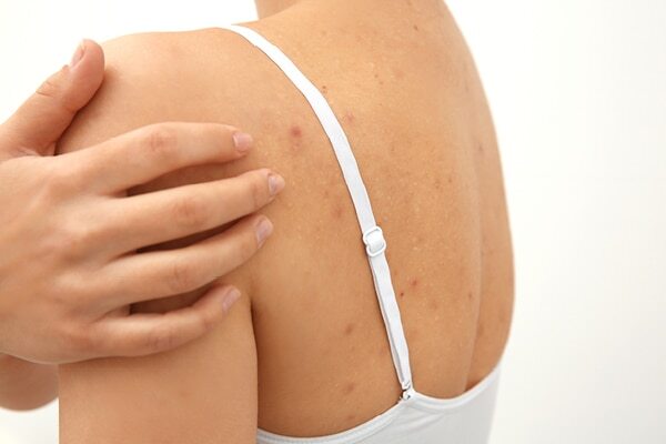FAQs about fungal acne treatment