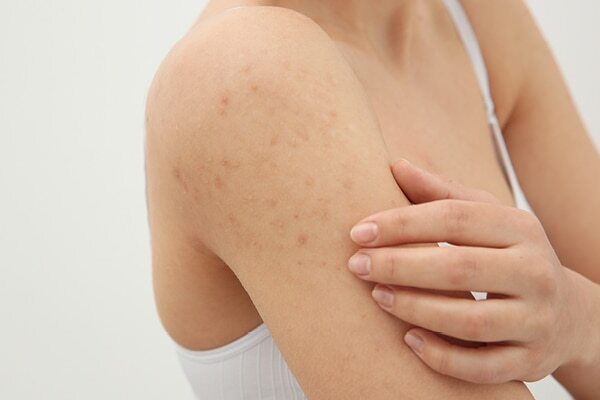 FAQs about fungal acne treatment