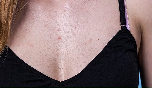 What Causes Chest Acne — And How To Deal With It