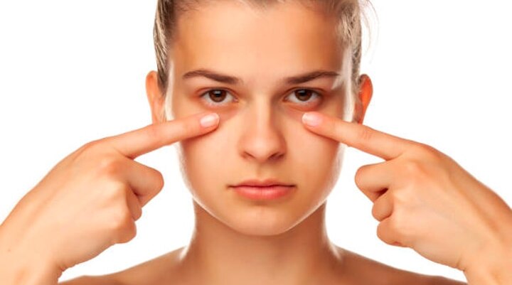 How To Remove Dark Circles: Top Techniques And Remedies