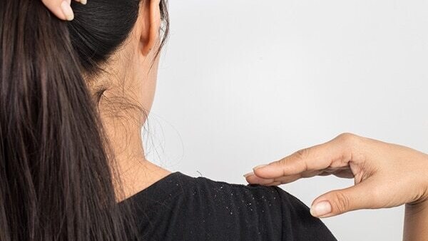 Ways to combat dandruff in summer