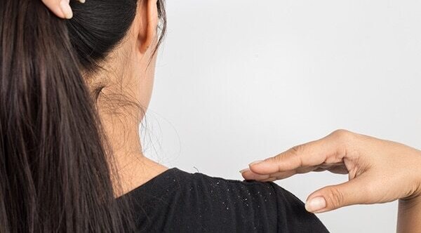 Ways to combat dandruff in summer
