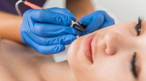 FAQs about electrolysis hair removal