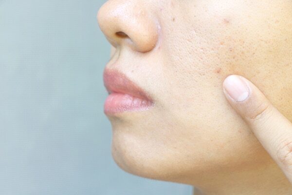 Prevents signs of ageing